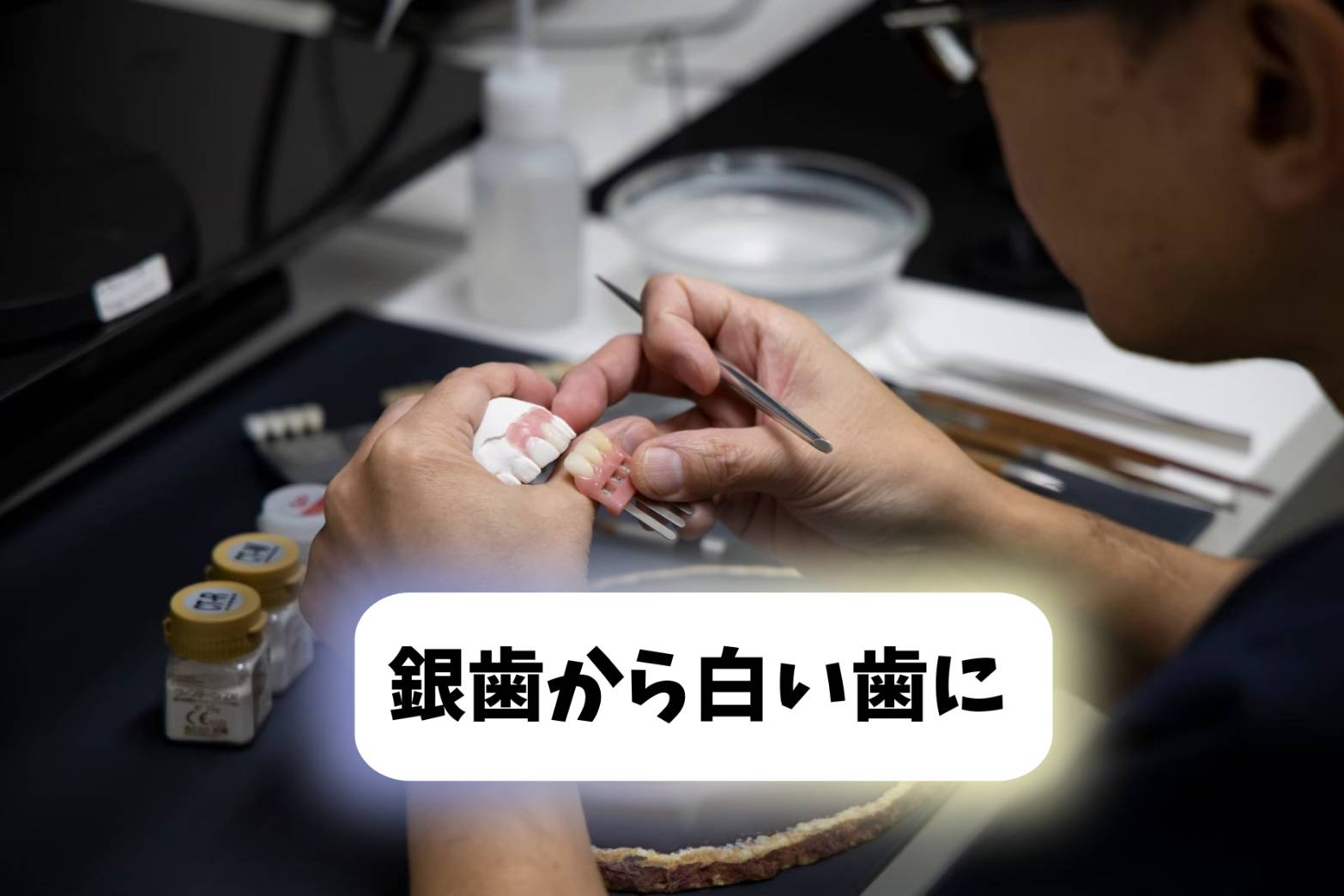 銀歯を白い歯に